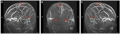 Cyclosporine-A-Induced Intracranial Thrombotic Complications: Systematic Review and Cases Report